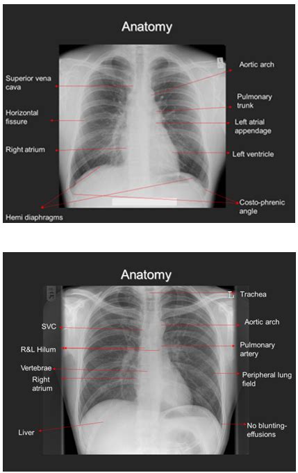 The Difference Between Chest Posterior Anterior Pa And Anterior