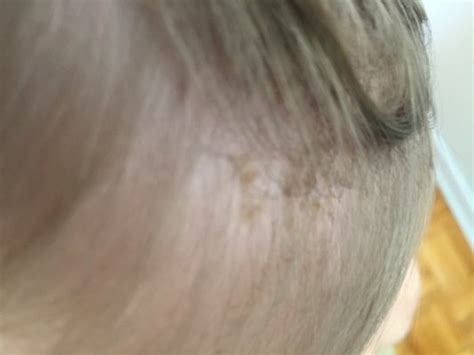 Brown Patches On Scalp Babycenter