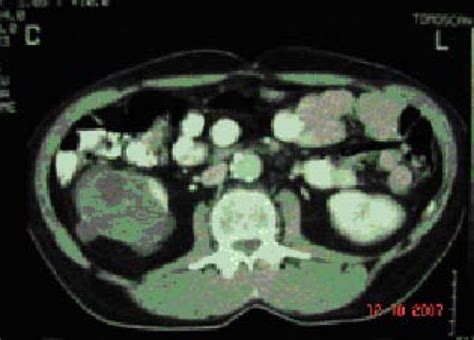 Cystic Nephroma Computed Tomography Image Download Scientific Diagram