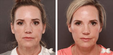 Facelift Before And After Utah Facial Plastics