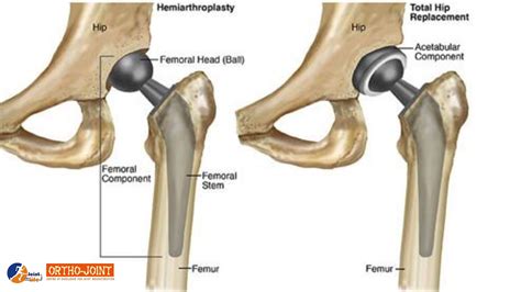 Revision Hip Replacement Surgery In India Ortho Joint