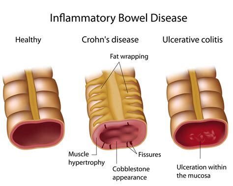 Inflammatory Bowel Disease Information ThirdAGE