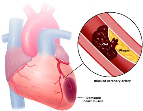 Dual Antiplatelet Therapy For Heart Disease Circulation