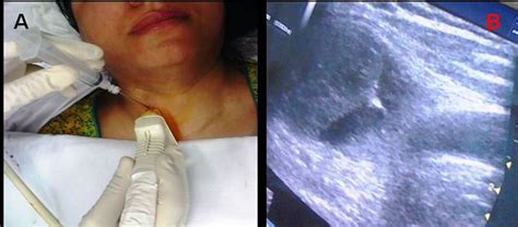 Evaluation Of Non Palpable Thyroid Nodules By Ultra Sound Guided Fine