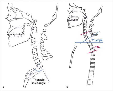 Upper Thoracic Osteotomy For Cervical Deformity Neupsy Key
