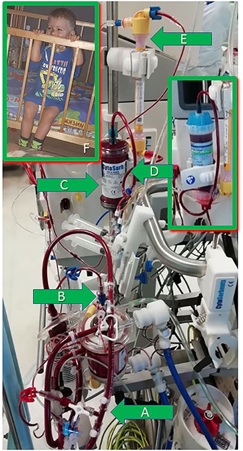 Frontiers Case Report Successful Use Of Extracorporeal Therapies After Ecmo Resuscitation In