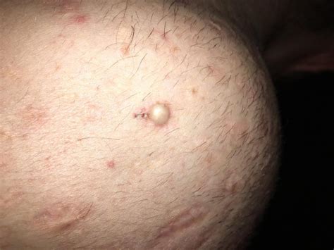 Hard Painless Lump On My Back What Could It Be Keloid Because Of My