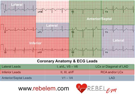 12 Lead Ekg Stemi Chart