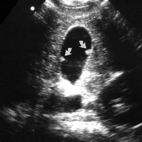 Abdominal Ultrasound Showing A Polypoid Lesion Of The Gallbladder