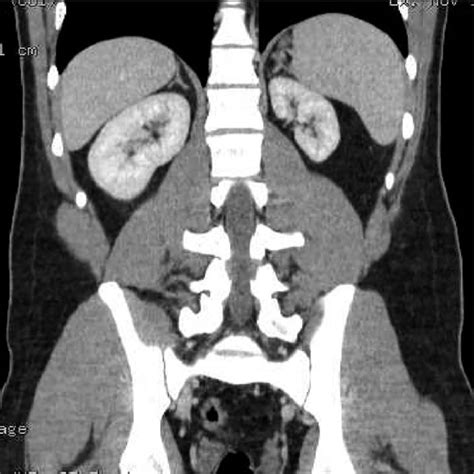 Abdominal Ct Scan Sagittal View Showed Normal Right Kidney And 70 Mm
