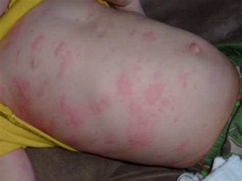 Clausen In The Hausen And Out In The Garden Viral Rash
