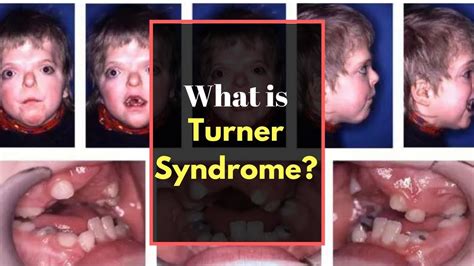 Turner Syndrome Symptoms Causes Pictures Signs And Symptoms Of