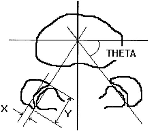 Drawing To Show The Measurement Of The Facet Joints Theta Is The
