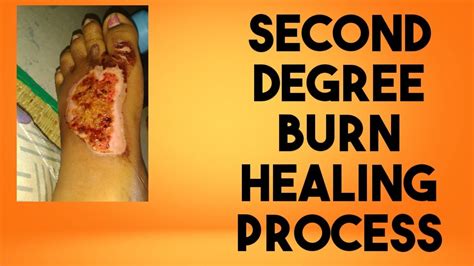 We did not find results for: Second degree burn Healing process/time - YouTube