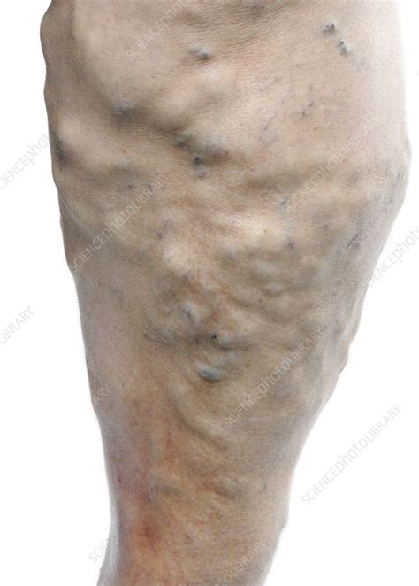 Varicose Veins In The Leg Stock Image C0166988 Science Photo Library
