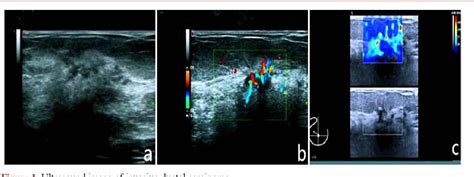 Figure 1 From Clinical Value Of Ultrasound Shear Wave Elastography In