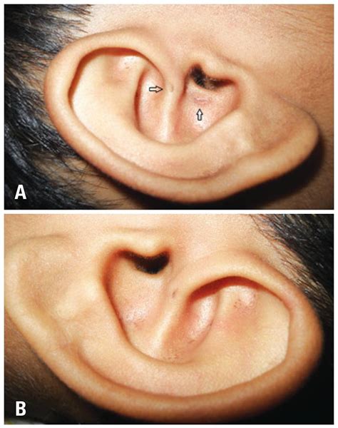 Scielo Brasil Of Periauricular Pits And Sinuses Understanding The