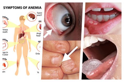 The Term Iron Deficiency Anemia Refers To A Condition Characterized By A Decrease In Red Blood
