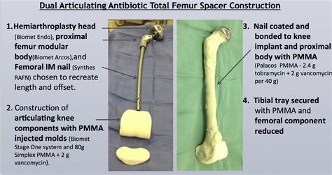 Creating A Dual Articulating Antibiotic Spacer For Management Of An