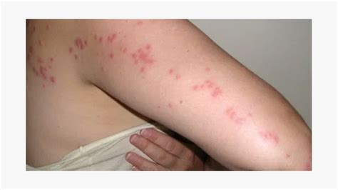 Can A Spider Bite Cause Hives Pest Phobia