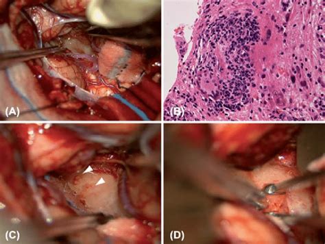 Intraoperative Photographs Showing The Dorsal Portion Of The Medulla Download Scientific