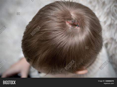 Lacerations Wound Head Image And Photo Free Trial Bigstock