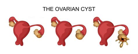 Ovarian cysts are very common. Ovarian Cyst, Jangan Ambil Mudah! - September 2020 ...
