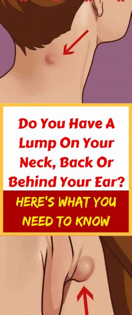 Do Youve Got A Lump On Your Neck Back Or Behind Your Ear That Is