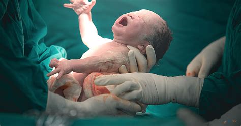Cesarean Section Procedure Indications Risks And Complications