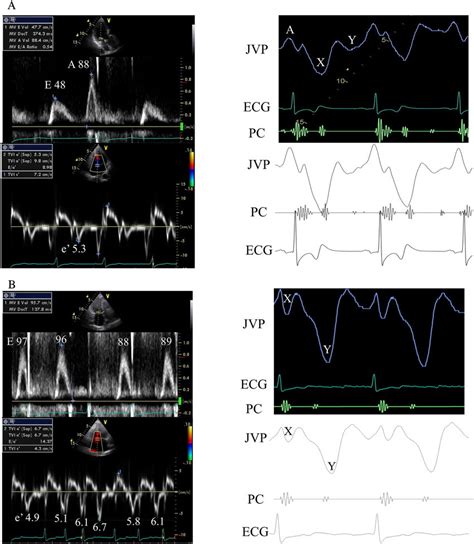 Assessment Of Echocardiography And The Jugular Venous Pulse The Mitral