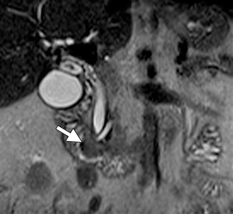 Imaging Features Of Benign And Malignant Ampullary And Periampullary