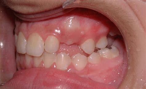 12 Months After The Extraction Of The Upper Left First Molar The