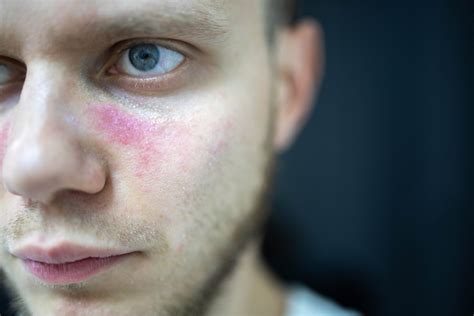 Premium Photo Age Spots Of Redness On The Face A Young Man Is Sick