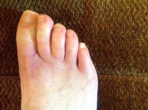 Anyone Gets Toes Like This Ive Been In The Lupus Uk
