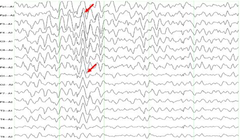 Eeg Demonstrating Diffuse Slowing With Epileptiform Abnormalities And