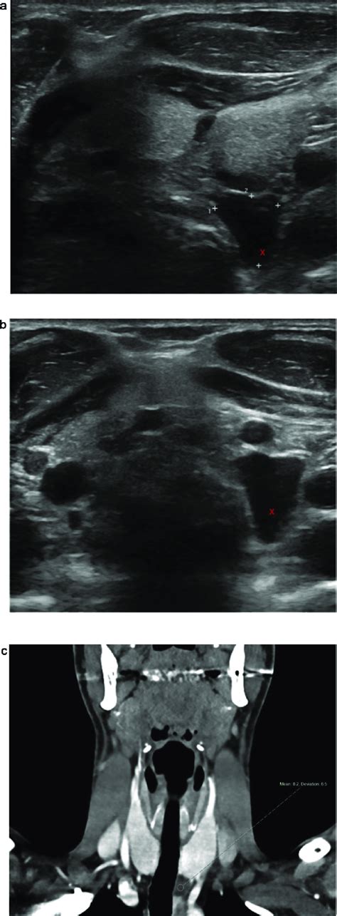 Cystic Parathyroid Gland A Transverse Ultrasound Images Through Download Scientific Diagram