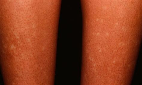 White Spots On Legs Causes And Fast Home Remedies Skincarederm