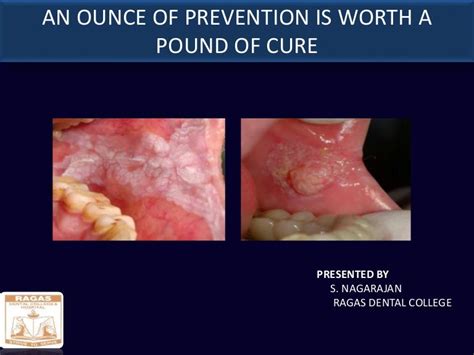 Early Diagnosis Of Oral Cancer