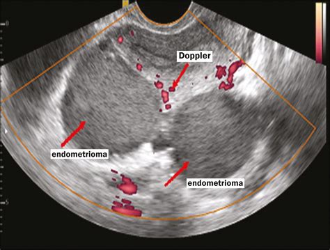 Transvaginal ultrasound in deep endometriosis: pictorial essay