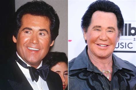 Learn about the ten most frequently performed cosmetic surgeries in the united states. Wayne Newton Plastic Surgery - With Before And After Photos