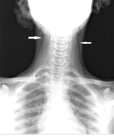 Soft Tissue Neck Radiograph Anteroposterior View Showing Air