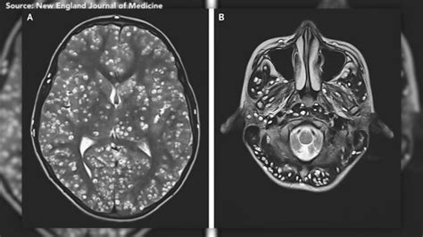 Teenager Dies Of Tapeworm Egg Infestation In Brain Abc7 Chicago