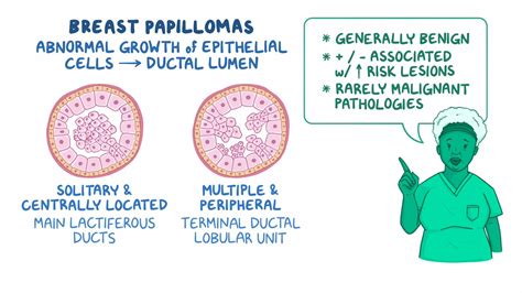 Breast Papilloma Clinical Sciences Osmosis Video Library
