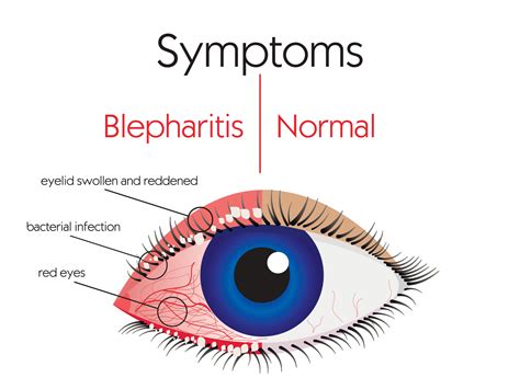Dry Eye And Blepharitis Symptoms And Causes Of Blepharitis