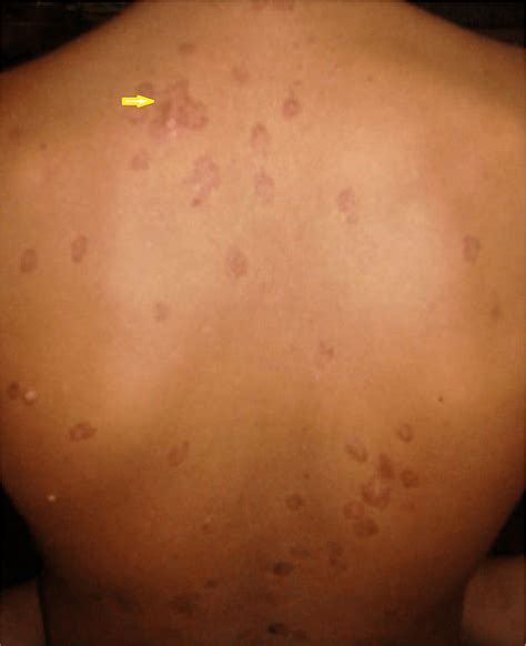 Cureus Para Kala Azar Dermal Leishmaniasis A Case Report