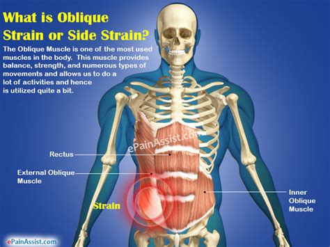 One of those includes the commotion happening in your abdomen. Oblique Strain or Side Strain|Causes|Symptoms|Treatment|Recovery Period