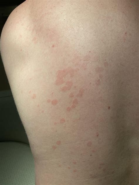 Rash On One Side Of Back For The Last Week Does Not Itch Is Not