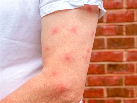 Mosquito Bites Allergy Treatment