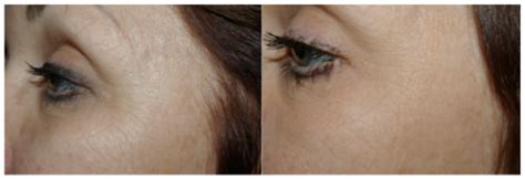 Best Treatment For Eye Wrinkles Dermatology Consultants