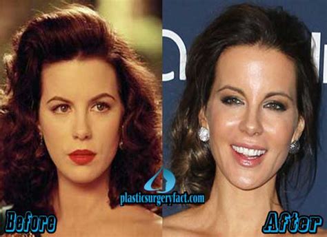 Kate Beckinsale Plastic Surgery Before and After